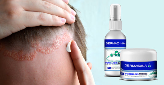 Psoriasis o Eczema, Conoce las Diferencias