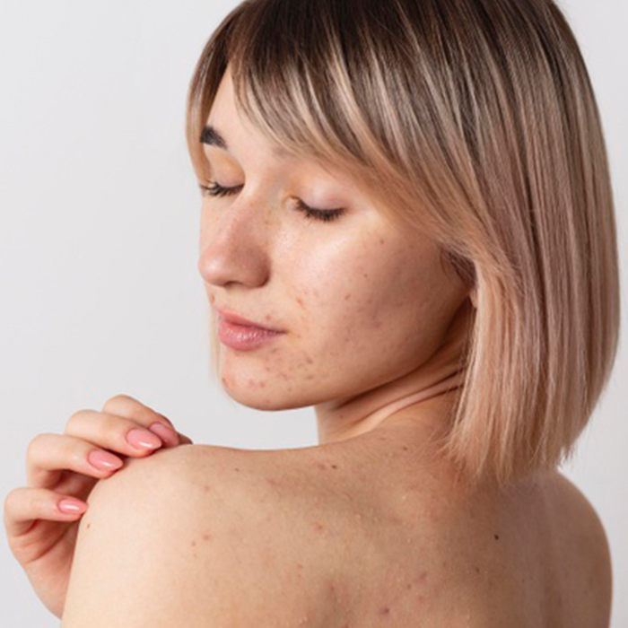 Combatir el acné con productos naturales ahora es posible