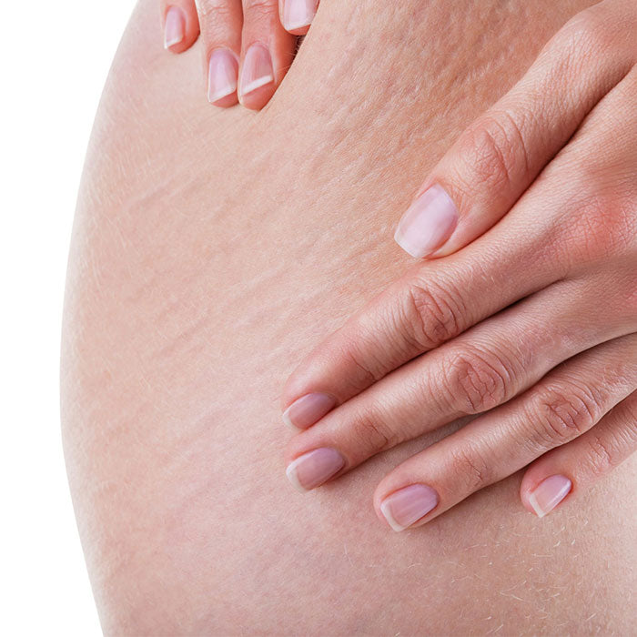 Dermaccina Stretch Marks elimina las estrías