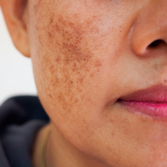 Dermaccina Whitening remueve las manchas de la piel