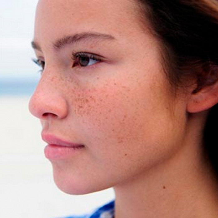 Dile adiós a las manchas con Dermaccina Whitening