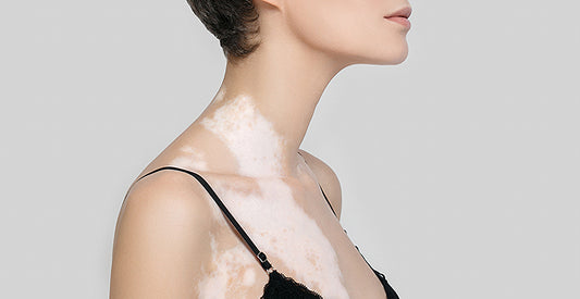 MEJORAR NATURALMENTE LAS MANCHAS POR VITILIGO