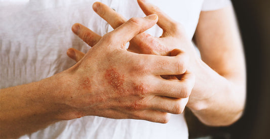 TRATAMIENTO PARA LA PSORIASIS