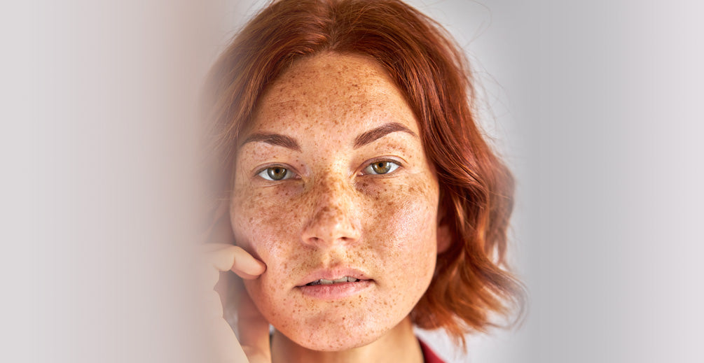 Todo lo que necesitas saber sobre el Melasma: Causas, Síntomas, Diagnóstico y Tratamiento