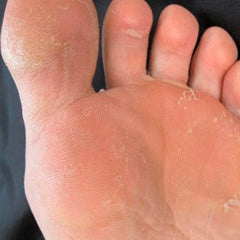El final de los hongos en los pies y el pie de atleta