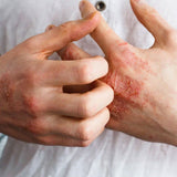 Dermaccina Psoriasis el tratamiento para combatir la psoriasis efectivamente