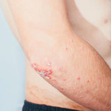 Dermaccina Psoriasis dile adiós a la Psoriasis