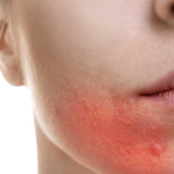 Dermaccina Rosacea Cream efectiva contra la rosácea