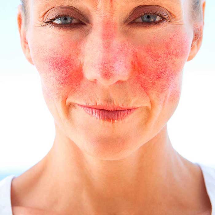 Dermaccina Rosacea Cream elimina el enrojecimiento facial