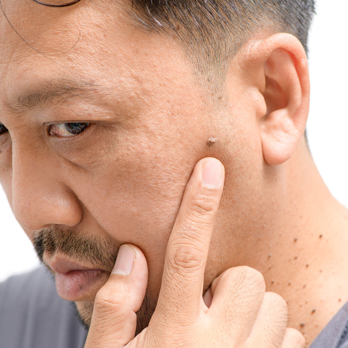 Elimina las verrugas con Dermaccina Skin Tags Corrector