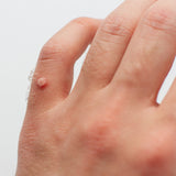 Di adiós para siempre a las verrugas con Dermaccina Skin Tag Corrector