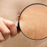 Previene la aparición de estrías con Dermaccina Stretch Marks