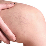 Dermaccina Varices Crema