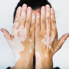 Dermaccina Vitiligo Spray