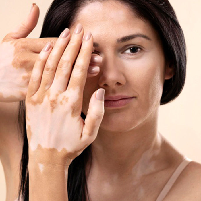 Con Dermaccina Vitiligo puedes disminuir las manchas en la piel